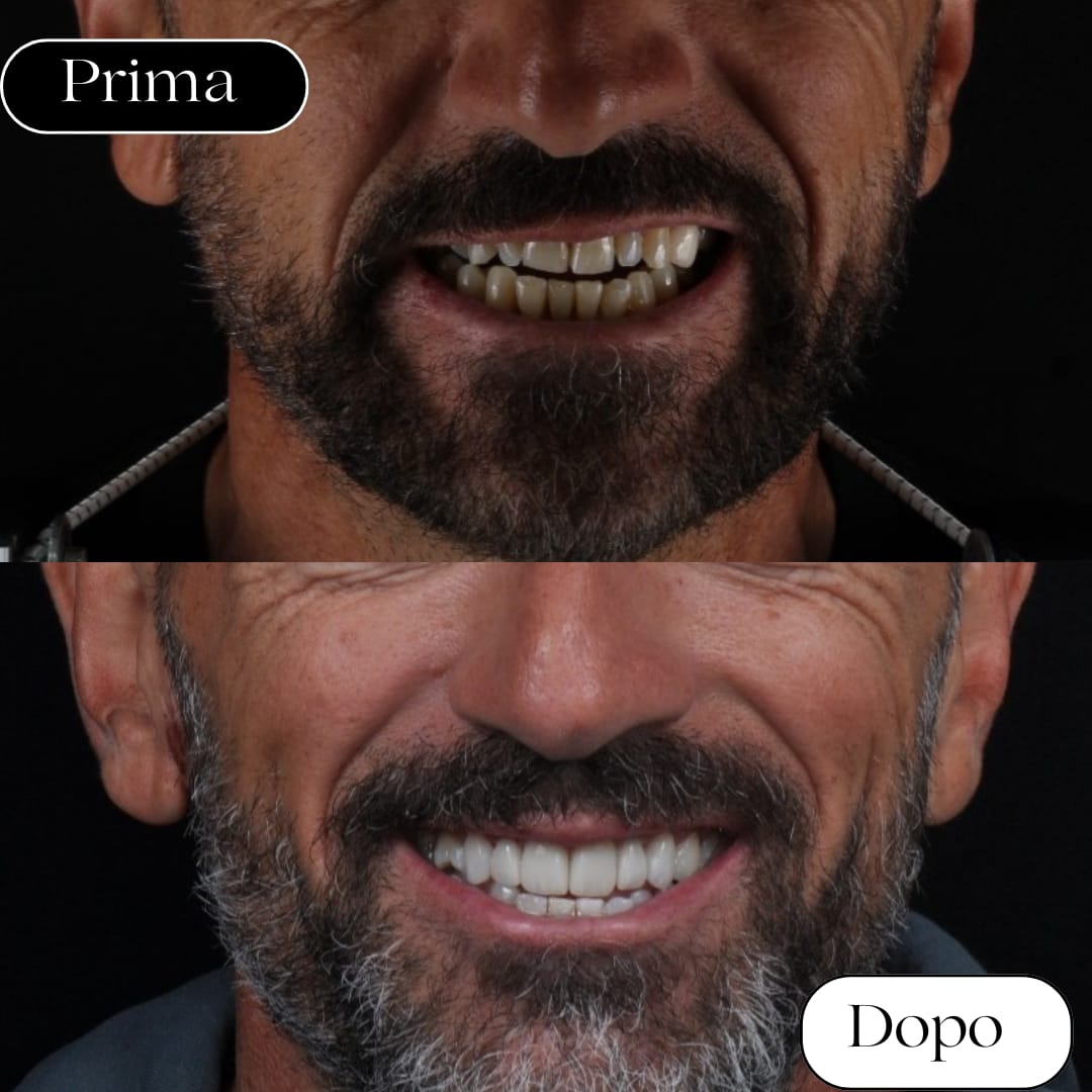 faccette dentali rizzuto