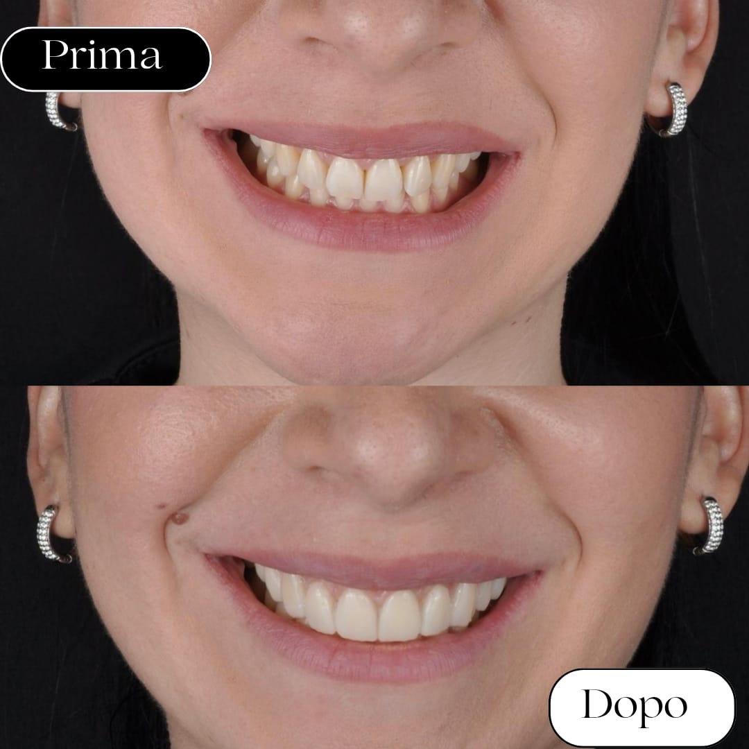 faccette dentali rizzuto